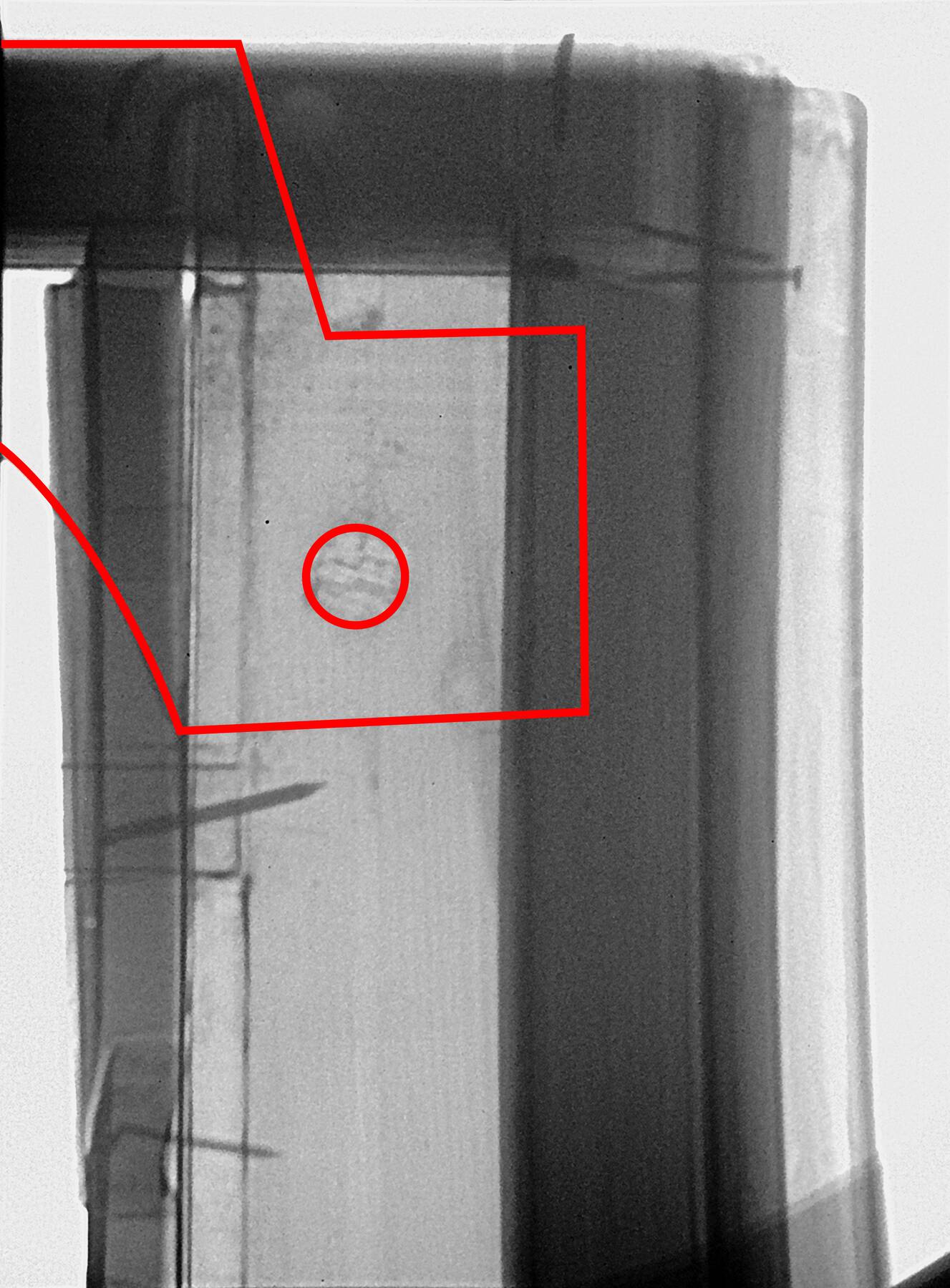 black-and-white x-ray with a red circle and irregular polygon superimposed on top to indicate the location of angled cuts